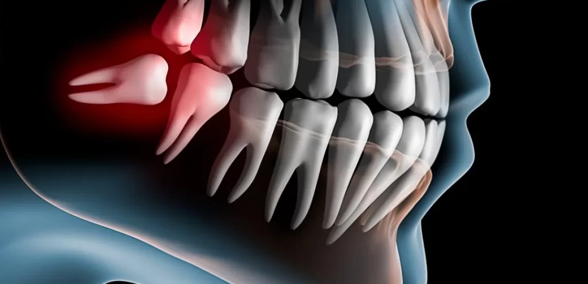 Extração do Dente Siso com Cirurgião buco-maxilo-facial (Exodontia Siso)